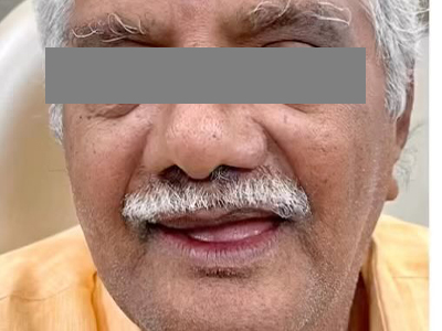 Smile Makeover - Before