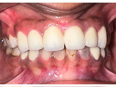Smile Designing - After