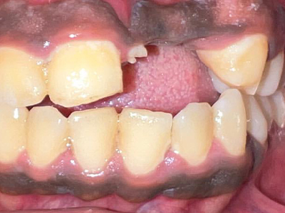 Dental Implants - Before