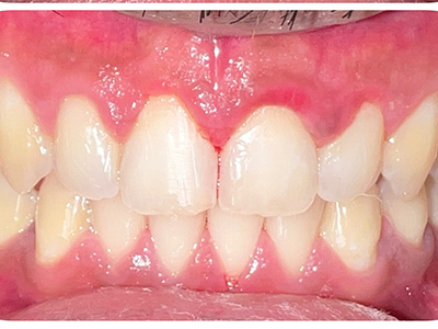 Orthodontic Treatment - After