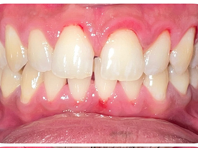 Orthodontic Treatment - Before