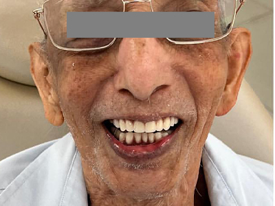 Full mouth rehablitation - After