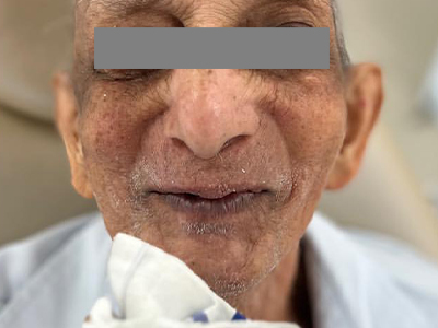 Full mouth rehablitation - Before